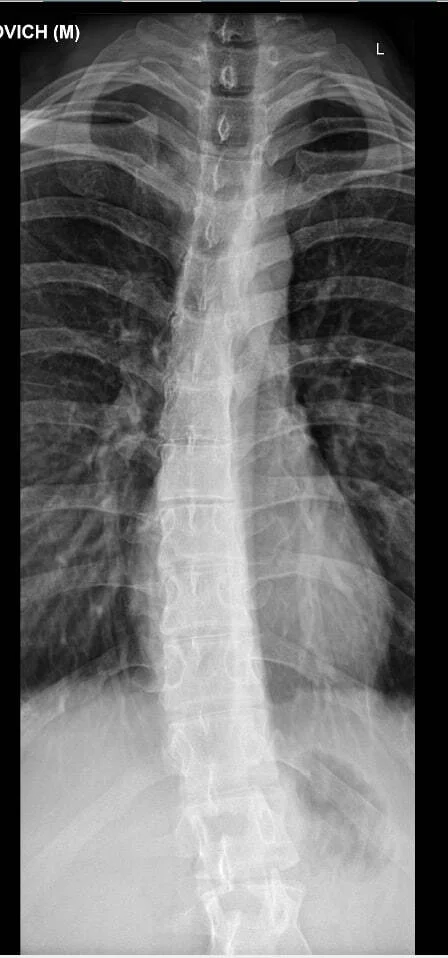 Scoliosis. Need advice - My, Scoliosis, Back, Operation, PHYSICAL THERAPY, Spine, Disease, Workout, Stretching, Health, Pain, Treatment, Exercises, Longpost