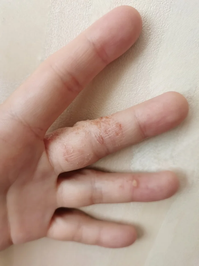 Need advice from a dermatologist - Dermatology, The medicine, Pregnancy, Eczema, Question