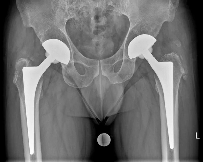Случаи из практики: протезы бывают разные - Моё, Медицина, Личный опыт, Протез, Протезирование, Суставы, Позвоночник, Рентгенология, Рентген, Рентгенолог, Кт, Длиннопост