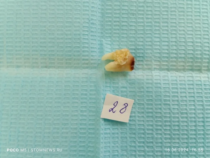 Removed 28th wisdom tooth with missing crown part - My, The medicine, Dentistry, Teeth, Opinion, Doctors, Polyclinic, Medications, Operation, Treatment