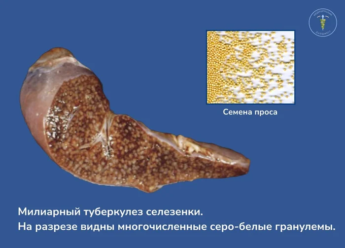 Милиарный туберкулез - Здоровье, Лечение, Медицина, Болезнь, Туберкулез, Селезенка