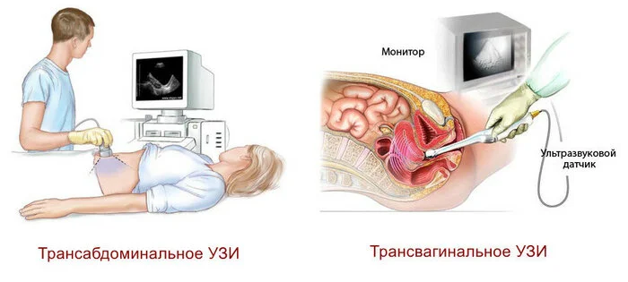 Ультразвуковое омоложение: прорыв в гинекологии для женского здоровья - Здоровье, Исследования, ЗОЖ, Медицина, Красота, Омоложение, Гинекология, Женщины, Ультразвук