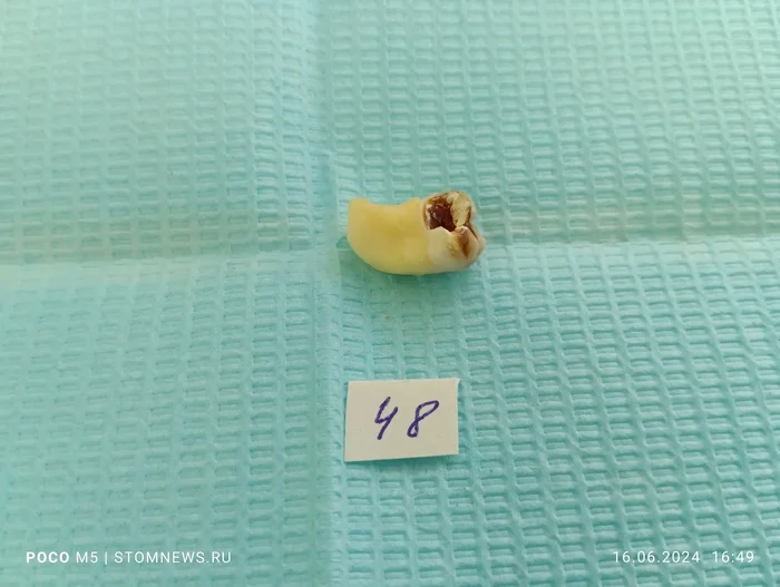 Removed 48 wisdom tooth with caries on the distal surface - My, The medicine, Dentistry, Teeth, Opinion, Doctors, Polyclinic, Medications, Treatment, Hospital, Operation, Disease, Disease history, Health