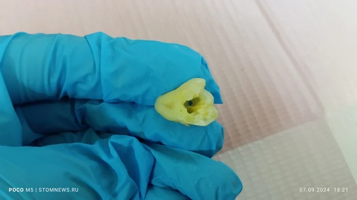 Removed 48 wisdom tooth with exposed pulp chamber - My, The medicine, Dentistry, Teeth, Opinion, Doctors, Polyclinic, Medications, Treatment, Hospital