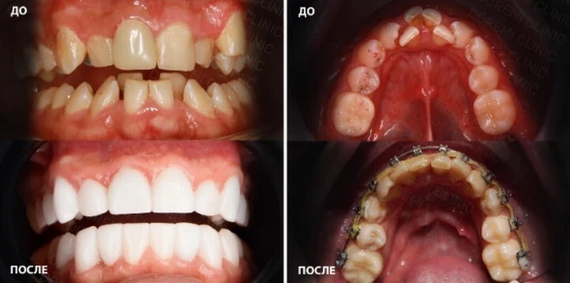Да, брекетами можно исправлять даже такое.