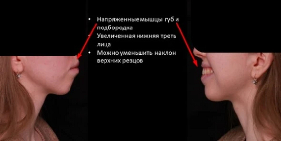 Когда пациентка закрывала рот, ее губы были напряжены. Это хорошо заметно даже на фото.