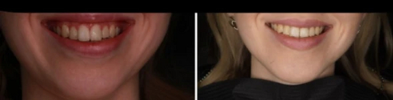 На фото слева - улыбка до лечения. Очень сильно видно десну. В целом выглядит эстетично, но пациентка постоянно страдала от пересыхания зубов и десен. На фото справа: десну не видно, мимическая мускулатура расслаблена, улыбка непринужденная и красивая.