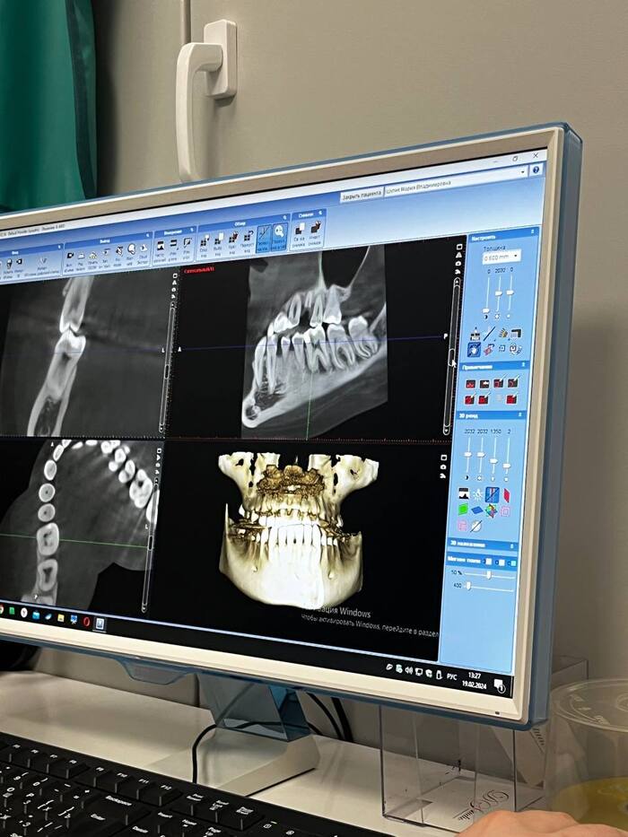 Need help with maxillofacial surgery. Distal bite - My, Maxillofacial Surgery, Distal bite, Jaw, Doctors need help, Doctors, Dentistry, Surgery, Orthodontics, Gnathology, Treatment, OMS, Quota, Question, Need advice