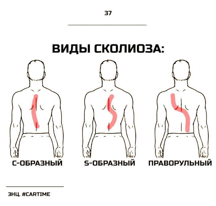 Сколиоз...
