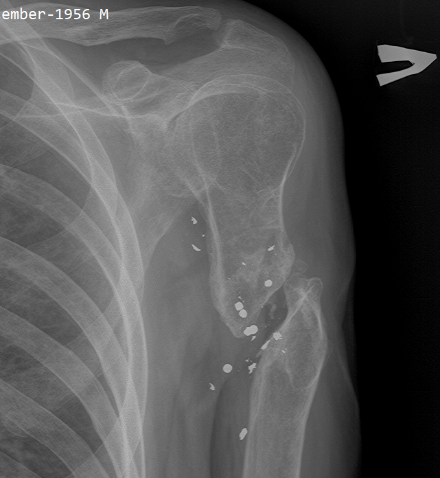 False joint - consequences of a shot to the shoulder - My, X-ray, Radiology, Wound