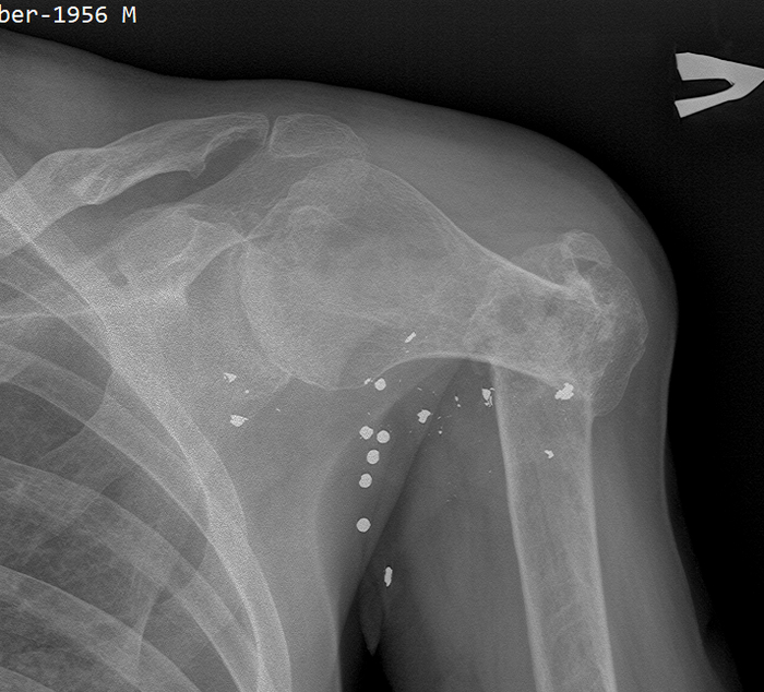 False joint - consequences of a shot to the shoulder - My, X-ray, Radiology, Wound