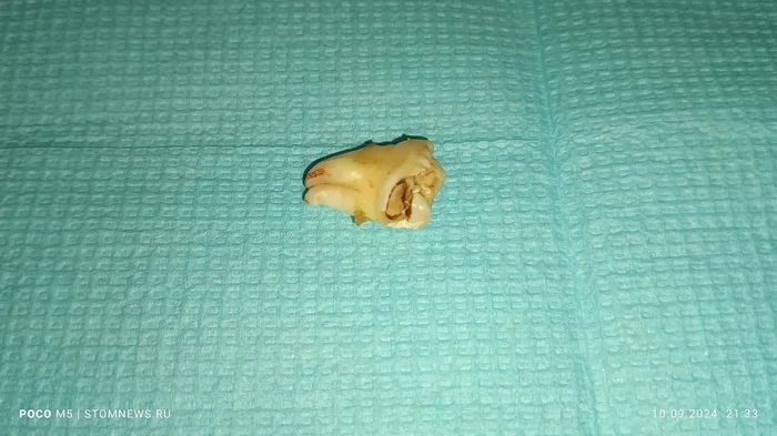 Photos of the removed 28th wisdom tooth with caries on the distal surface - My, The medicine, Dentistry, Teeth, Opinion, Doctors, Polyclinic, Medications, Treatment, Disease history, Hospital, Operation, Disease, Health