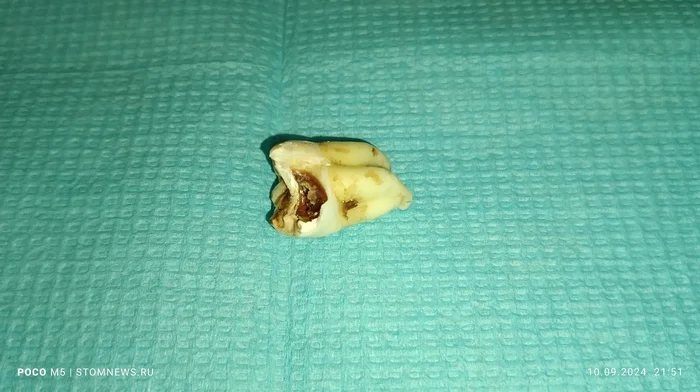 Photos of the removed 48 lower wisdom tooth with caries on the lingual surface - My, The medicine, Dentistry, Teeth, Opinion, Doctors, Polyclinic, Medications, Treatment, Disease history, Hospital, Operation, Disease, Health