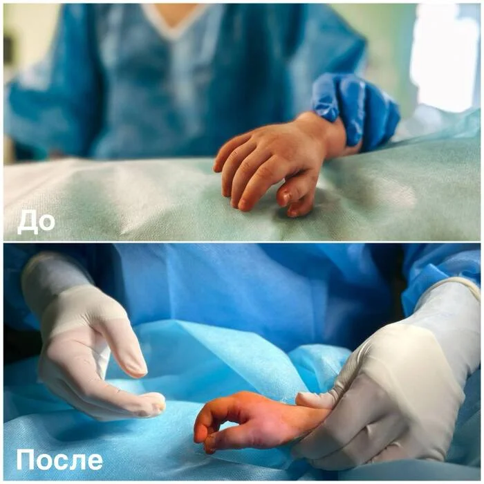 Polydactyly: Doctors Remove Extra Finger From 18-Month-Old - The medicine, Operation, Surgery, Doctors, Fingers, Moscow, Video, VKontakte (link), Longpost, Children