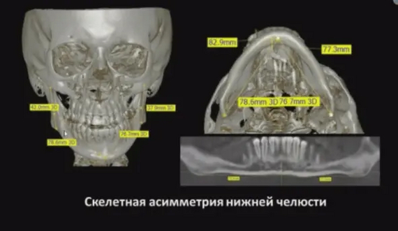 The orthodontist suggested removing a healthy tooth: should you agree? - My, Dentistry, The medicine, Treatment, Teeth, Health, Orthodontics, Extraction of teeth, Operation, Disease, Longpost