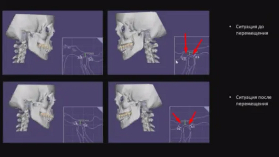 The orthodontist suggested removing a healthy tooth: should you agree? - My, Dentistry, The medicine, Treatment, Teeth, Health, Orthodontics, Extraction of teeth, Operation, Disease, Longpost