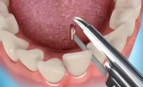 The orthodontist suggested removing a healthy tooth: should you agree? - My, Dentistry, The medicine, Treatment, Teeth, Health, Orthodontics, Extraction of teeth, Operation, Disease, Longpost