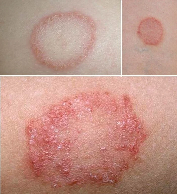 From the practice of a pediatrician: what kind of rash is this? - My, The medicine, Health, Rash, Doctors, Pediatrician, Longpost, Dermatology, Rare diseases