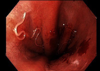 Stomach worms (anisakiasis) after eating raw fish - My, Treatment, The medicine, Research, Disease history, Translated by myself, Parasites