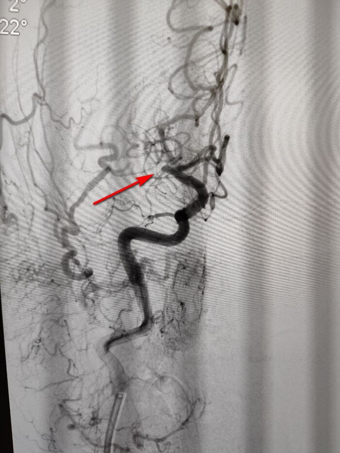 Стрелкой - место окклюзии