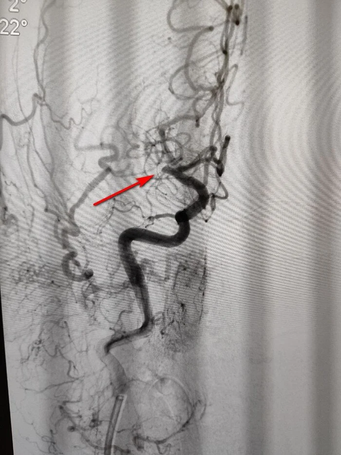 Современное лечение ишемического инсульта - тромбэктомия - Моё, Инсульт, Ишемический инсульт, Тромб, Лечение, Операция, Видео, Вертикальное видео, Длиннопост
