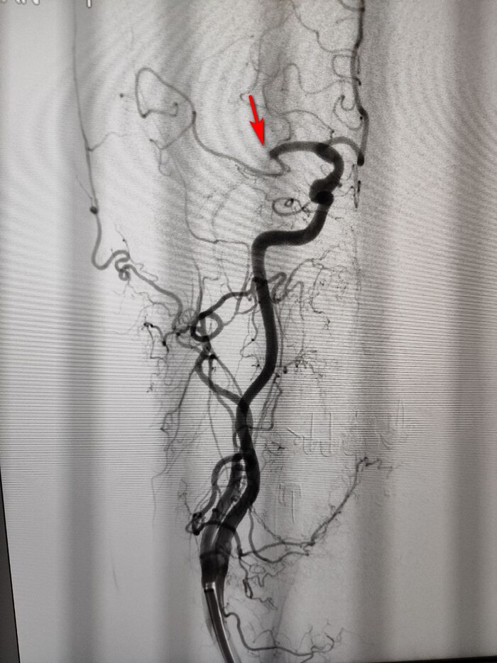 Стрелка - место окклюзии (закупорки)
