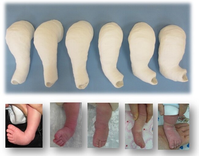 Clubfoot and clubfoot - My, The medicine, Health, Talipes, Feet, Longpost, Children