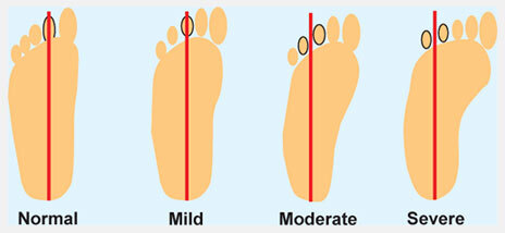 Clubfoot and clubfoot - My, The medicine, Health, Talipes, Feet, Longpost, Children