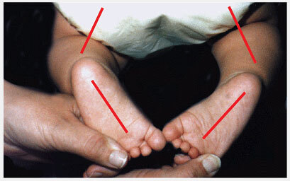 Clubfoot and clubfoot - My, The medicine, Health, Talipes, Feet, Longpost, Children