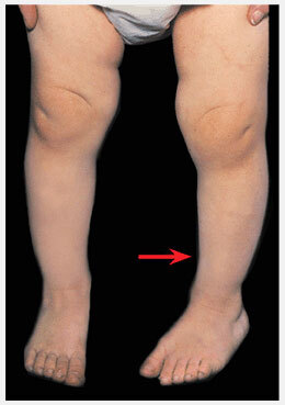 Clubfoot and clubfoot - My, The medicine, Health, Talipes, Feet, Longpost, Children