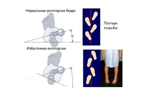 Косолапость и косолапие - Моё, Медицина, Здоровье, Косолапость, Стопы, Длиннопост, Дети