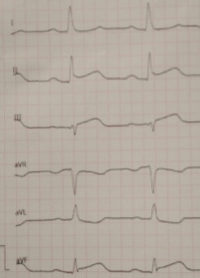 Типичный нижний инфаркт, причём совсем свежий, студенческий вариант.