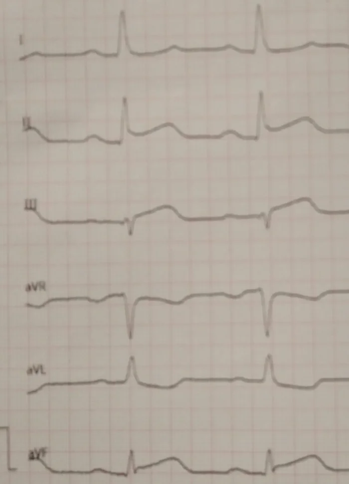 Инфаркт миокарда у 19-летнего пациента - Врачи, Скорая помощь, История болезни, Яндекс Дзен, Яндекс Дзен (ссылка), Длиннопост