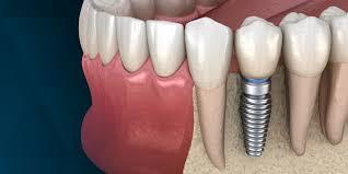 Dental implants. Which one to choose? - Dentistry, Dental implantation, Operation