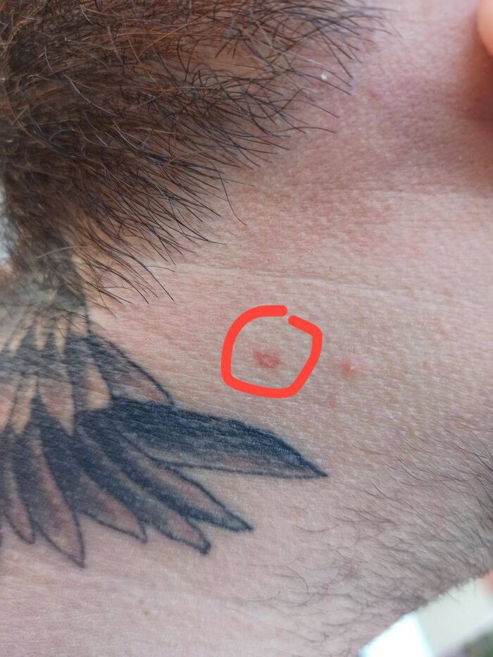 Пятно на коже с красным ,,ободком"