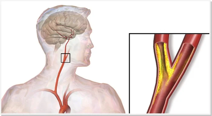 Cholesterol decreased, but the plaque in the vessel increased - Doctors, Ambulance, Disease history, Yandex Zen, Yandex Zen (link), Longpost