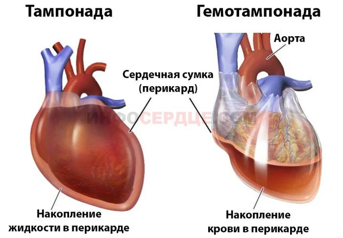 Stab wound to the heart. An unusual case in intensive care - Doctors, Ambulance, Negative, Disease history, Yandex Zen, Yandex Zen (link), Longpost