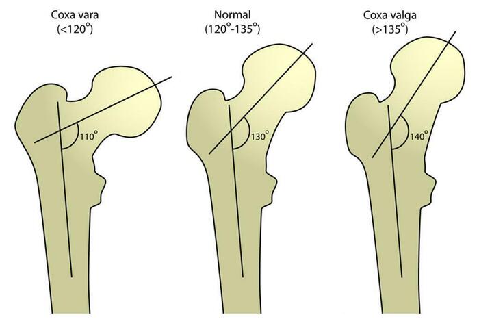 Coxa vara , , , , , , ,   , , , 