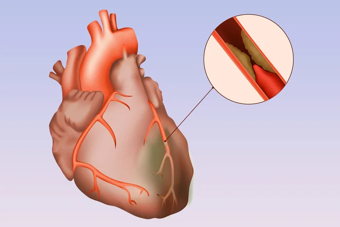 Severe atherosclerosis of the heart vessels with normal cholesterol - Doctors, Ambulance, Disease history, Yandex Zen, Yandex Zen (link), Longpost