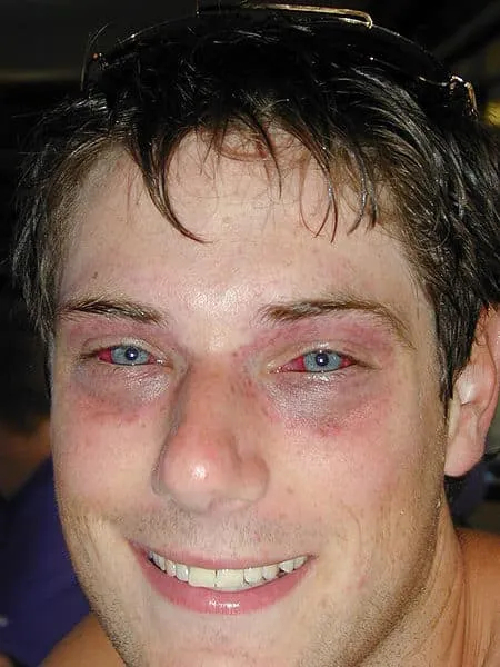 Я не смог найти свою фотку с баротравмой глаза, вот вам какой-то рандомный мужик из интернетов, который очень похож на чувака из мема, которого часто вставляют в посты, где как-то фу.