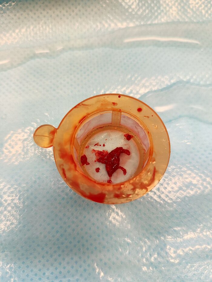 Тромб который отсосали