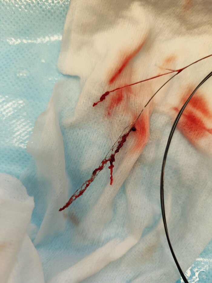 Тромб который зацепили