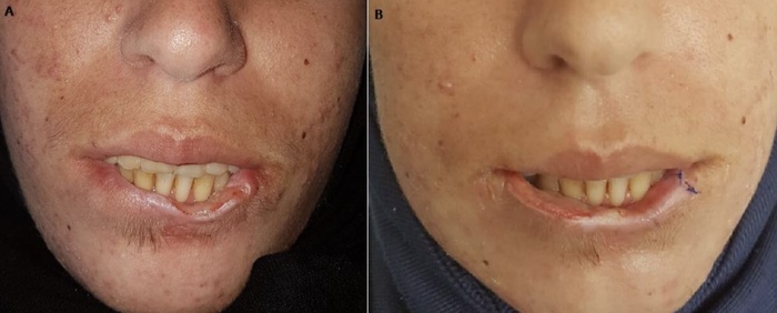 Самопоедание нижней губы