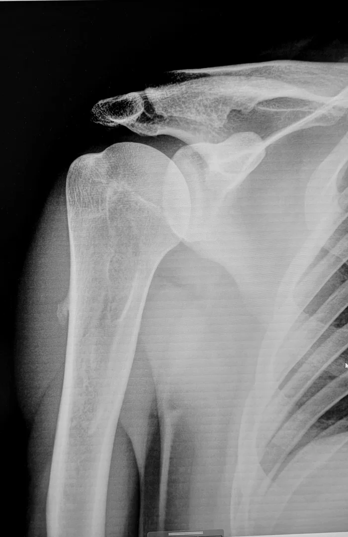 Bone cyst of the humerus - My, The medicine, Army, Cyst, Bones, X-ray, Radiology, Conscripts, Military enlistment office, Longpost