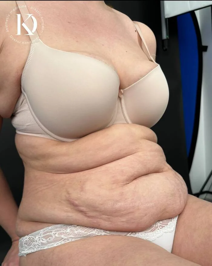 Okay, I admit, these are different people (I think it will be easier to believe) - My, Abdominoplasty, Doctors, Video, Vertical video, Longpost, Plastic surgery