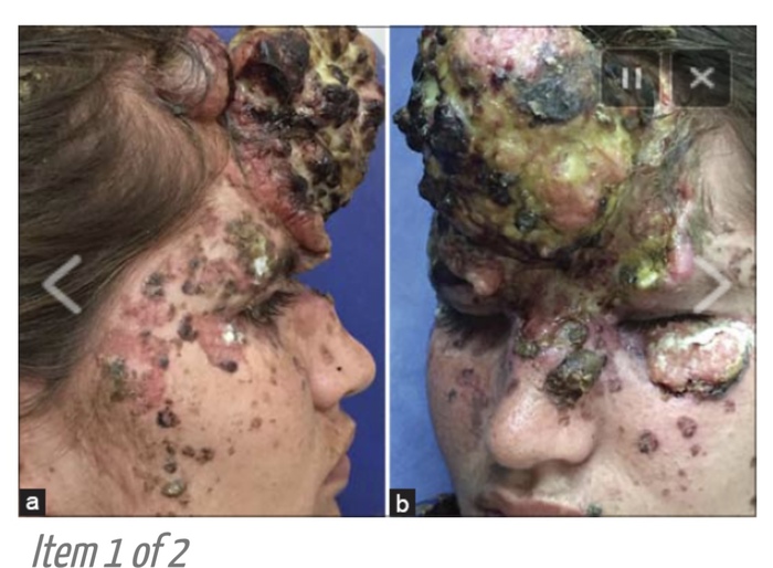 Клиническая картина, свидетельствующая о бородавчатом разрастании в центре и множественных покрытых коркой бляшках и изъязвлениях с обеих сторон на лбу у пациента с БЭ.