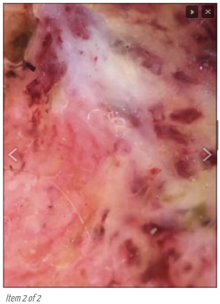 Дермоскопическое изображение, на котором видны множественные бесструктурные участки молочно-белого цвета, желтоватые однородные участки, кровоизлияния и эрозии на фоне эритемы с короткими, линейными и полиморфными сосудами, что указывает на SCC.