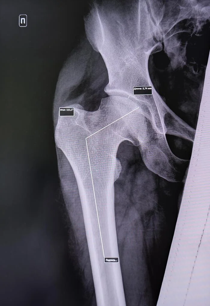 Dysplastic coxarthrosis - My, The medicine, Army, Military enlistment office, Bones, Joints, X-ray, Radiology, Orthopedics, Conscripts, Coxarthrosis, Dysplasia, Longpost