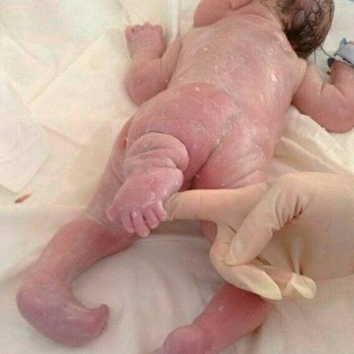 Клинический случай новорожденного с дополнительной конечностью