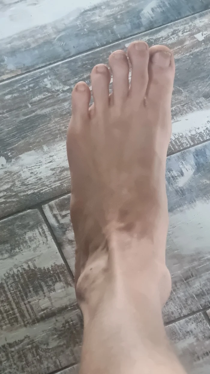 Lump on the outside of the foot - My, Heels, Feet, Question, Ask Peekaboo, Longpost